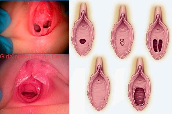 Hình ảnh lồn con gái còn trinh và đã mất trinh - Ảnh các loại màng trinh ở nữ